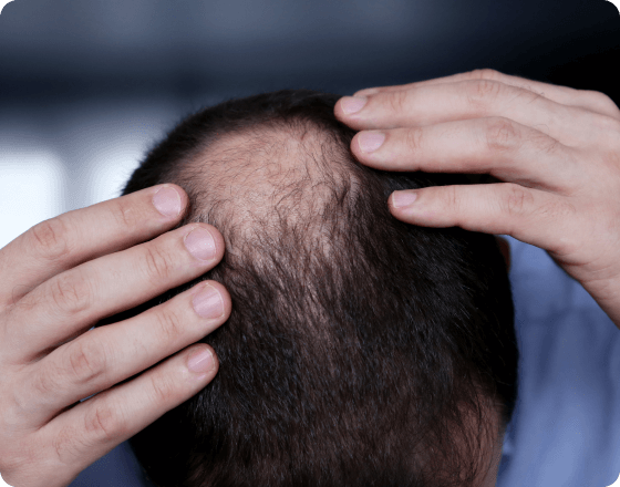Hair Loss